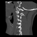 Clay-shoveler fracture (Radiopaedia 22568-22590 Sagittal bone window 12).jpg