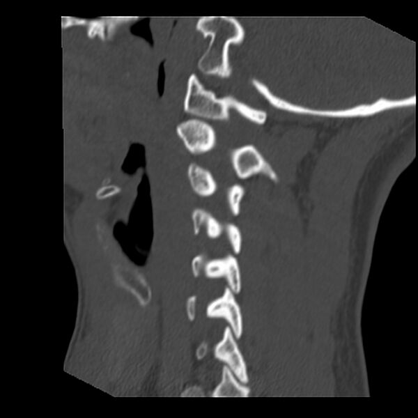 File:Clay-shoveler fracture (Radiopaedia 22568-22590 Sagittal bone window 12).jpg