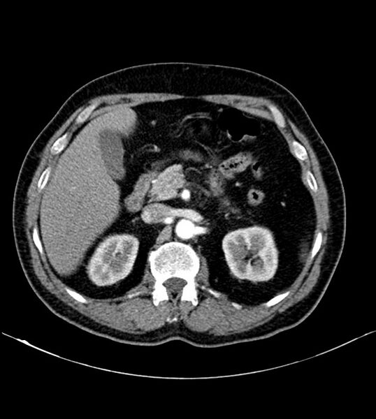File:Clear cell renal cell carcinoma (Radiopaedia 85006-100539 B 32).jpg