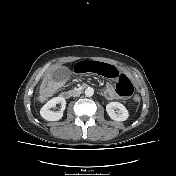 File:Closed loop bowel obstruction and ischemia (Radiopaedia 86959-103180 A 34).jpg