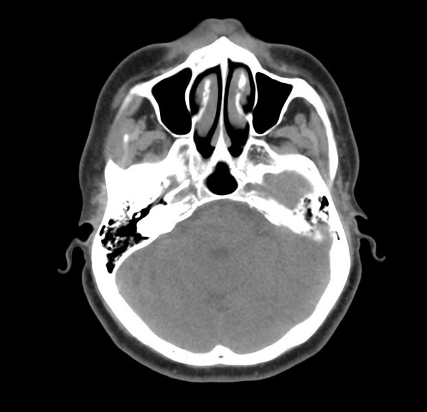 File:Colloid cyst of thyroid (Radiopaedia 22897-22923 Axial non-contrast 3).jpg