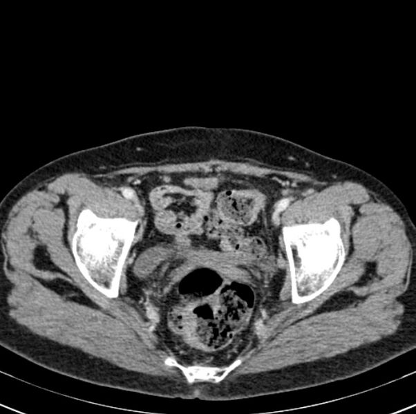 File:Colon carcinoma with hepatic metastases (Radiopaedia 29477-29961 A 103).jpg