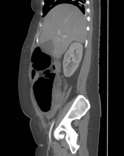 File:Colonic pseudo-obstruction (Radiopaedia 79752-92980 C 26).png