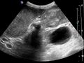 Gallbladder carcinoma (Radiopaedia 7684) (cropped).jpg