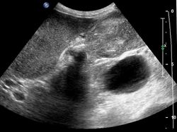 Gallbladder carcinoma on ultrasound