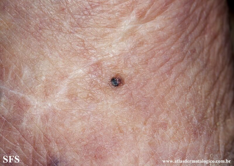File:Melanoma (Dermatology Atlas 100).jpg