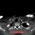Nasopharyngeal carcinoma recurrence - skull base destruction (Radiopaedia 29107-29491 A 35).jpg
