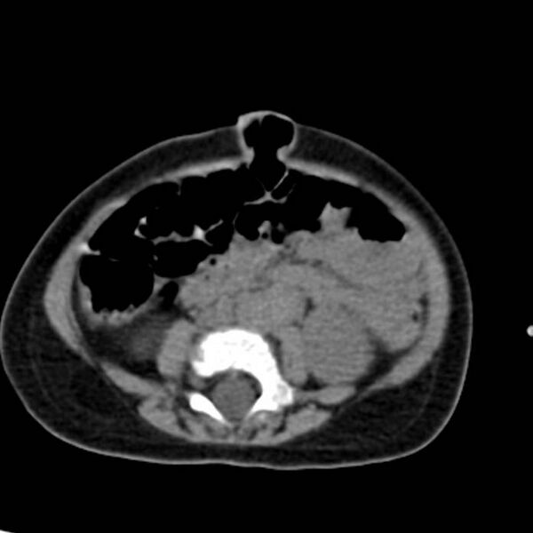 File:Neuroblastoma with skull metastases (Radiopaedia 30326-30960 Axial non-contrast 37).jpg
