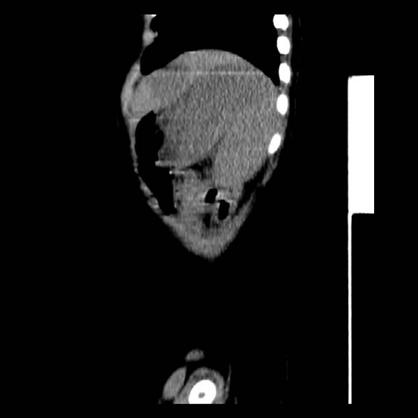 File:Neuroblastoma with skull metastases (Radiopaedia 30326-30960 B 41).jpg