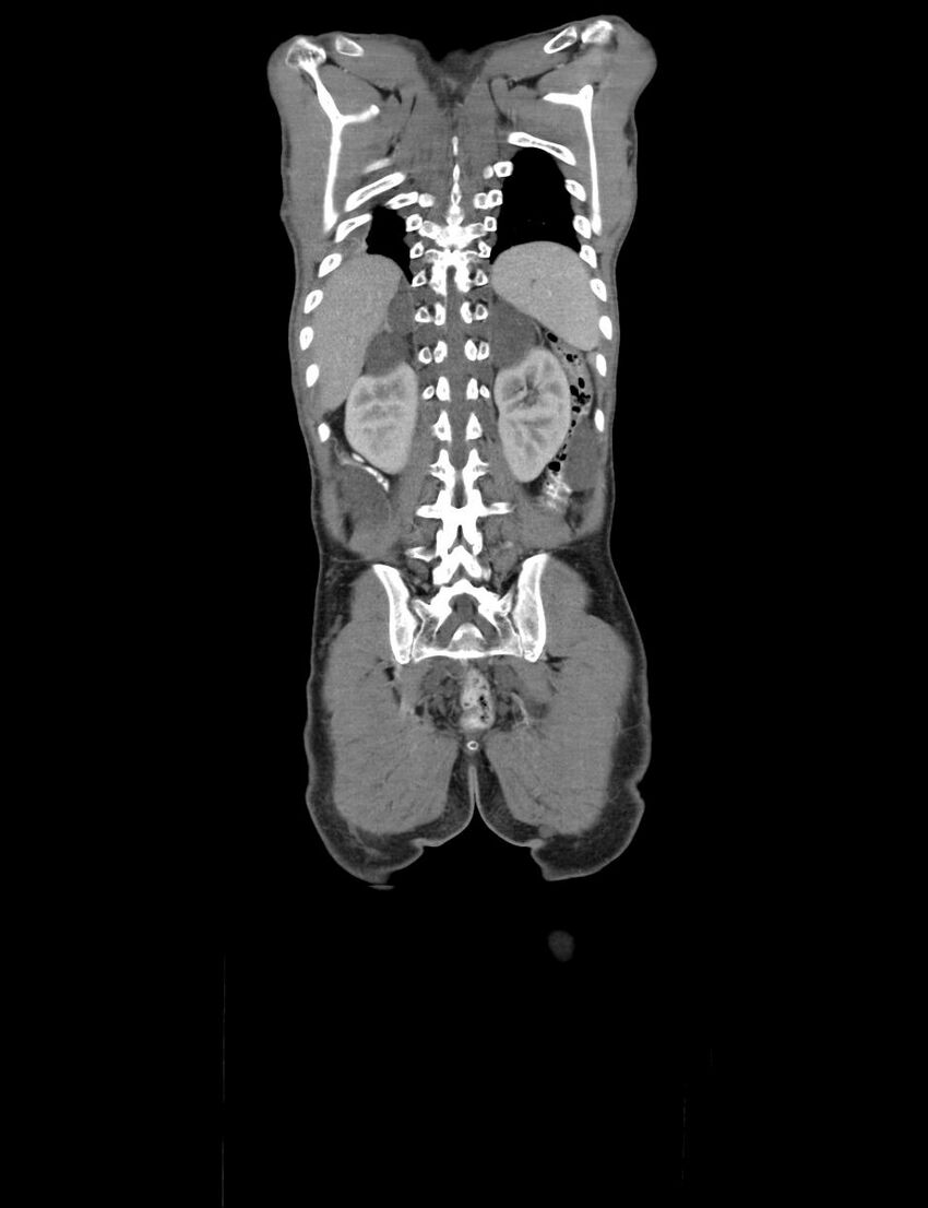 Neurofibromatosis type 1 (Radiopaedia 49538-54733 B 7).jpg