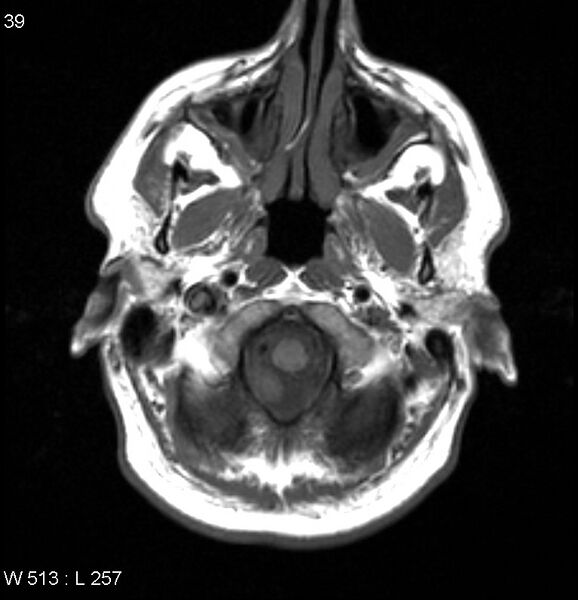 File:Neurosarcoidosis (Radiopaedia 10930-17204 Axial T1 1).jpg