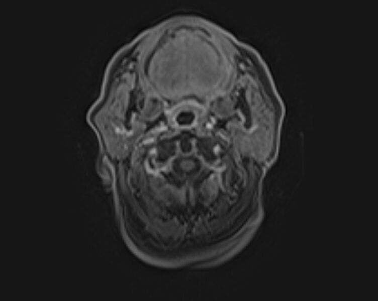 File:Non-Hodgkin lymphoma - parotid gland (Radiopaedia 71531-81890 E 13).jpg