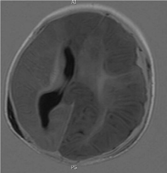 File:Non-accidental injury - intracranial injuries and skull fracture (Radiopaedia 17753-17509 Axial T1 1).jpg