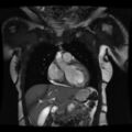 Non-compaction of the left ventricle (Radiopaedia 38868-41062 1CH SSFP CINE 7).jpg
