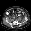 Non Hodgkin lymphoma in a patient with ankylosing spondylitis (Radiopaedia 84323-99621 Axial non-contrast 49).jpg