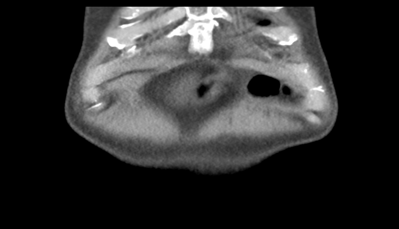 File:Normal CT intravenous cholangiogram (Radiopaedia 38199-40208 Coronal IVC 5).png