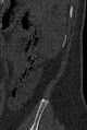 Normal CT lumbar spine (Radiopaedia 53981-60118 Sagittal bone window 110).jpg