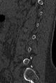 Normal CT lumbar spine (Radiopaedia 53981-60118 Sagittal bone window 71).jpg