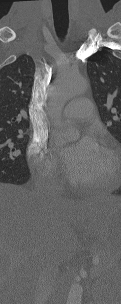 File:Normal CT thoracic spine (Radiopaedia 40181-42688 Coronal bone window 2).png