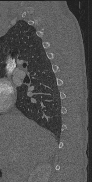 File:Normal CT thoracic spine (Radiopaedia 40181-42688 Sagittal bone window 56).png