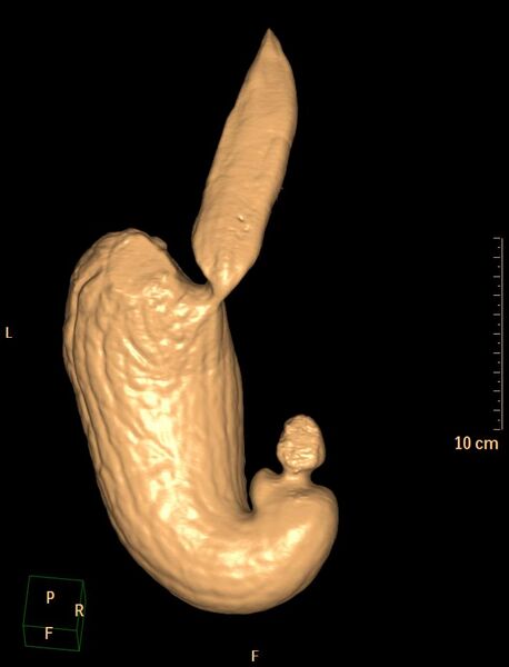 File:Normal CT virtual gastroscopy (Radiopaedia 29960-30501 3D VG 19).jpg