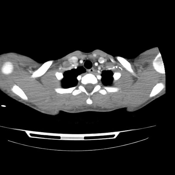 File:Normal dual-phase trauma CT chest,abdomen and pelvis (Radiopaedia 48092-52899 A 5).jpg