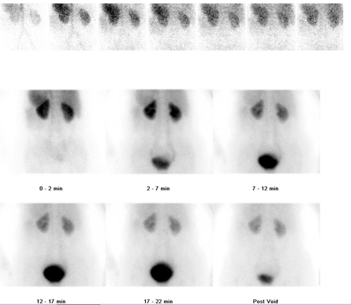File:Normal dynamic renal scintigraphy (Radiopaedia 91103-108671 A 1).png
