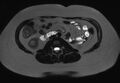 Normal liver MRI with Gadolinium (Radiopaedia 58913-66163 E 6).jpg