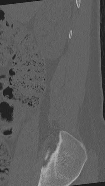 File:Normal lumbar spine CT (Radiopaedia 46533-50986 Sagittal bone window 92).png