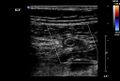 Normal vermiform appendix (Radiopaedia 9553-40788 A 3).jpg