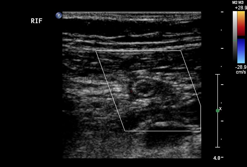 File:Normal vermiform appendix (Radiopaedia 9553-40788 A 3).jpg