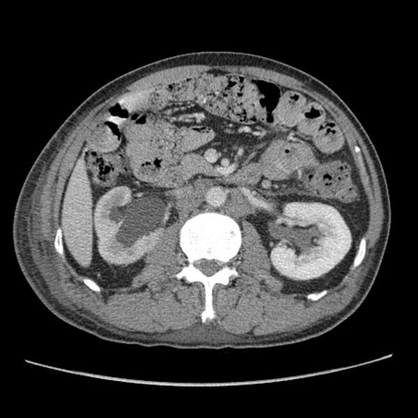 File:Obstructive bladder transitional cell carcinoma (Radiopaedia 9825-10410 A 10).jpg