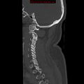 Occipital condyle fracture (Radiopaedia 18366-18208 Sagittal bone window 9).jpg