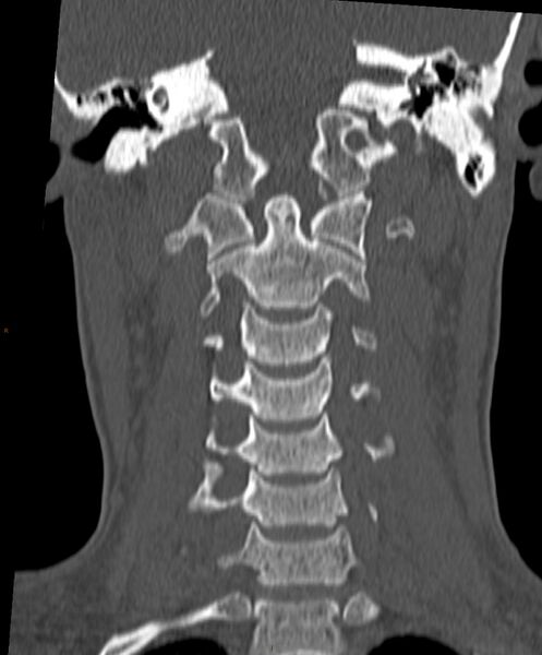 File:Occipital condyle fracture (Radiopaedia 61165-69056 Coronal bone window 9).jpg