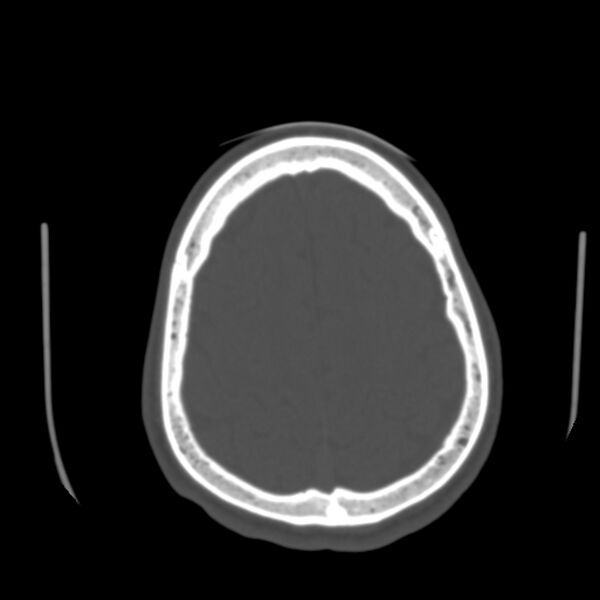 File:Occipital spur - asymptomatic (Radiopaedia 87753-104201 Axial bone window 172).jpg