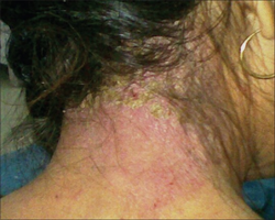 PPD contact allergic dermatitis