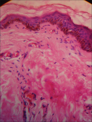 Increased melanization of the basal layer with slightly atrophic epidermis (H and E, ×40)
