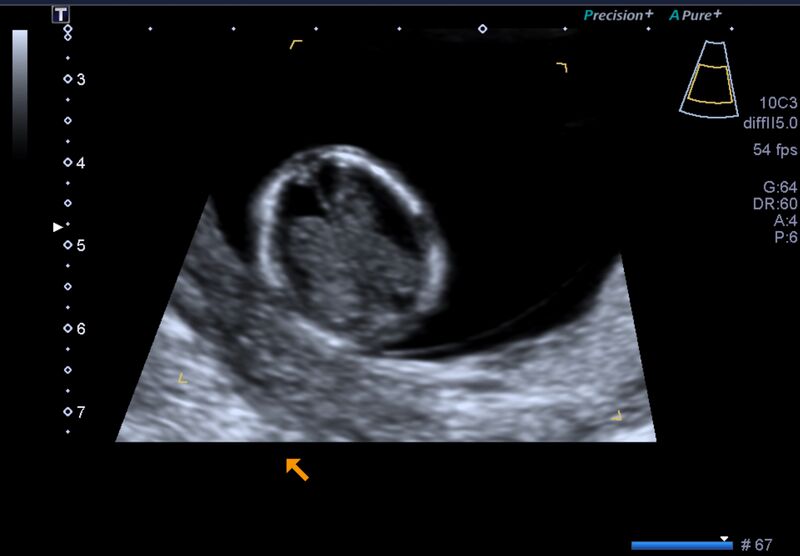 File:1st trimester nuchal-morphology ultrasound (Radiopaedia 44706-48477 General anatomy and NT 7).jpg