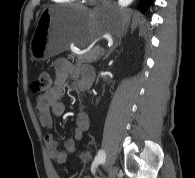 File:Abdominal aortic aneurysm (Radiopaedia 22421-22458 D 29).jpg