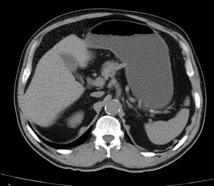 File:Abdominal aortic aneurysm (Radiopaedia 22421-22458 non-contrast 14).jpg