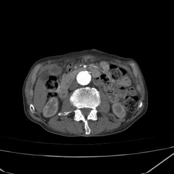 File:Abdominal aortic aneurysm (Radiopaedia 23703-23856 Axial C+ arterial phase 36).jpg