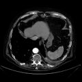 Abdominal aortic aneurysm (Radiopaedia 25855-26001 Axial C+ arterial phase 21).jpg