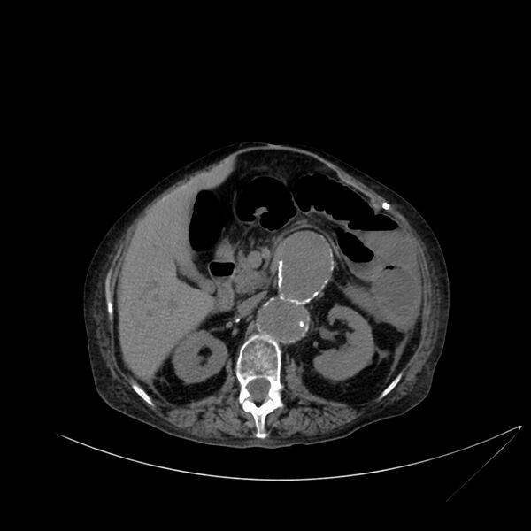 File:Abdominal aortic aneurysm - impending rupture (Radiopaedia 19233-19246 Axial non-contrast 50).jpg