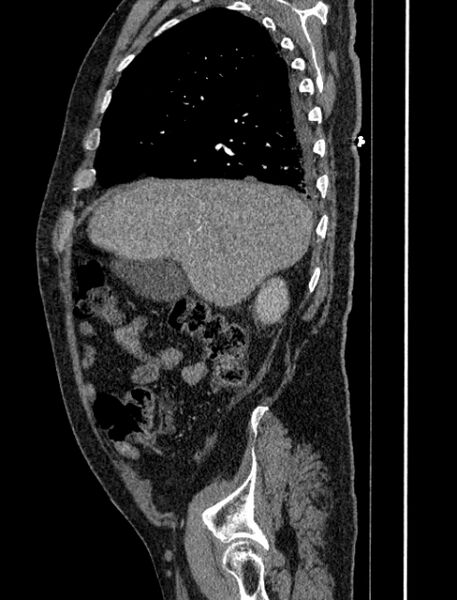 File:Abdominal aortic aneurysm rupture (Radiopaedia 54179-60362 Sagittal C+ arterial phase 8).jpg