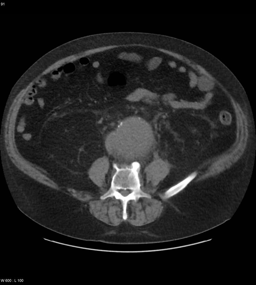 Abdominal aortic aneurysm with intramural hematoma then rupture (Radiopaedia 50278-55631 Axial non-contrast 87).jpg