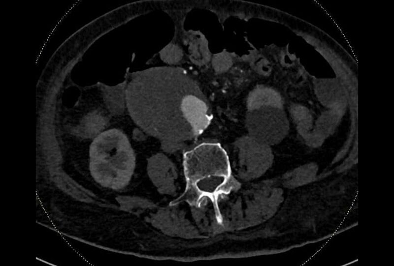 File:Abdominal aortic aneurysm with thrombus fissuration (Radiopaedia 73192-83919 Axial C+ arterial phase 124).jpg