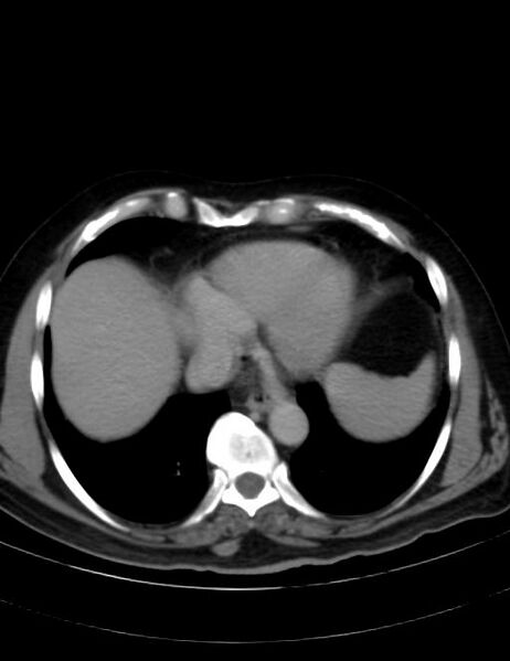 File:Abdominal lymphoma - with sandwich sign (Radiopaedia 53486-59492 Axial C+ portal venous phase 4).jpg
