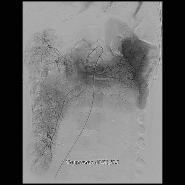 File:Abernethy malformation (Radiopaedia 42006-45462 Frontal Superior mesenteric artery 9).jpg