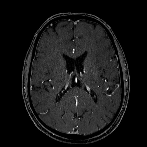 File:Accessory middle cerebral artery (Radiopaedia 73114-83828 Axial MRA 124).jpg