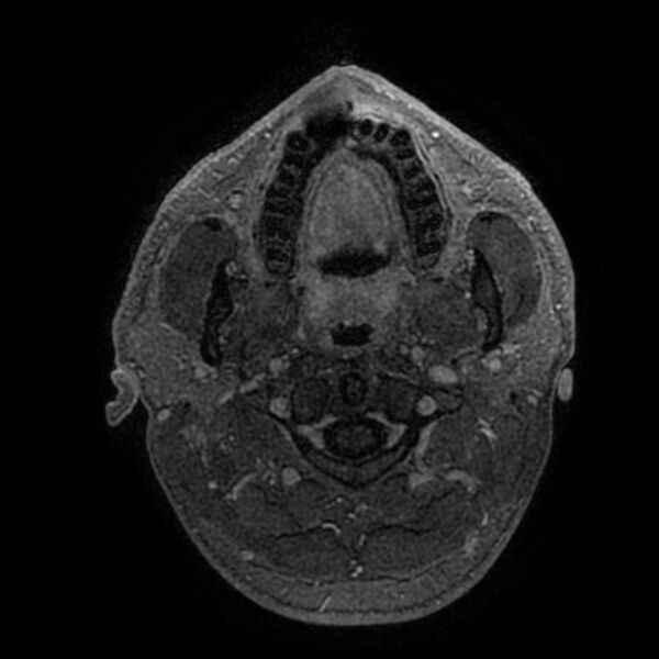 File:Acoustic schwannoma - intracanalicular (Radiopaedia 37247-39024 Axial T1 C+ 3).jpg
